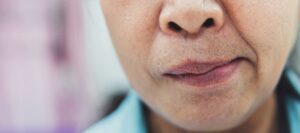 Belova paraliza i Cranial Facial Release (CFR)
